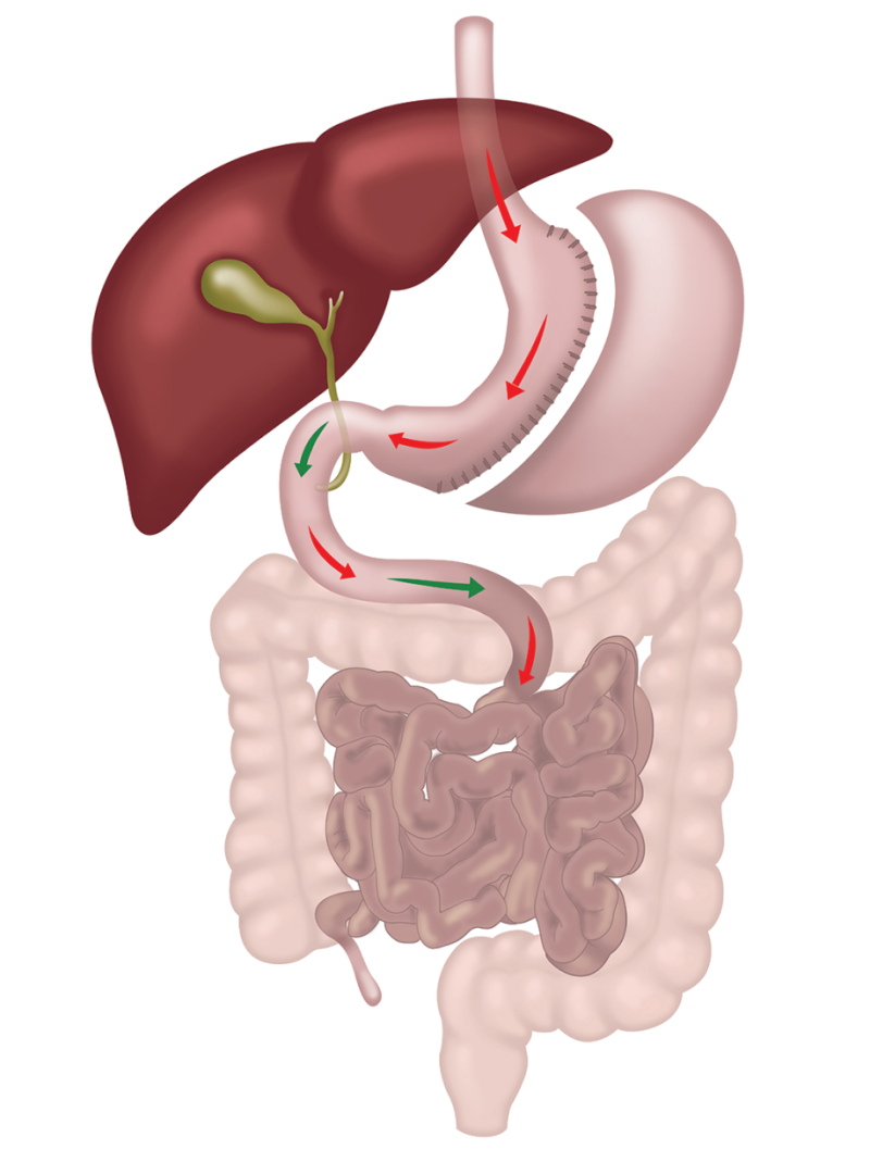 Sleeve Gastrectomy Vertical or tube gastrectomy